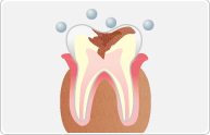 虫歯とは