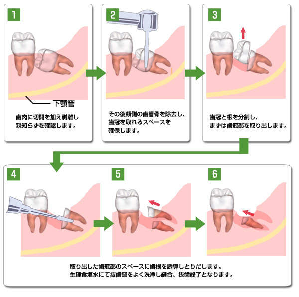 親知らず 顎 の 骨 削る