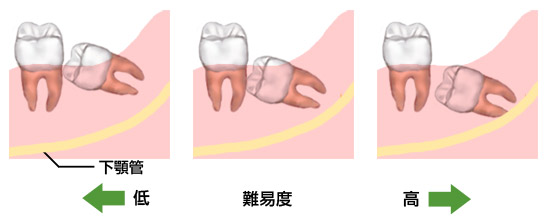 横向き 親知らず 横向きの親知らずの抜歯をしてから抜糸までの1週間の痛みと腫れの経過