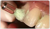 （3）歯科医院専用の歯ブラシで歯面清掃