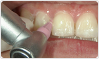 （4）歯の隣接面（歯と歯の間）の清掃