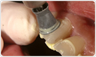 （5）仕上げ磨き・歯面研磨・フロッシング
